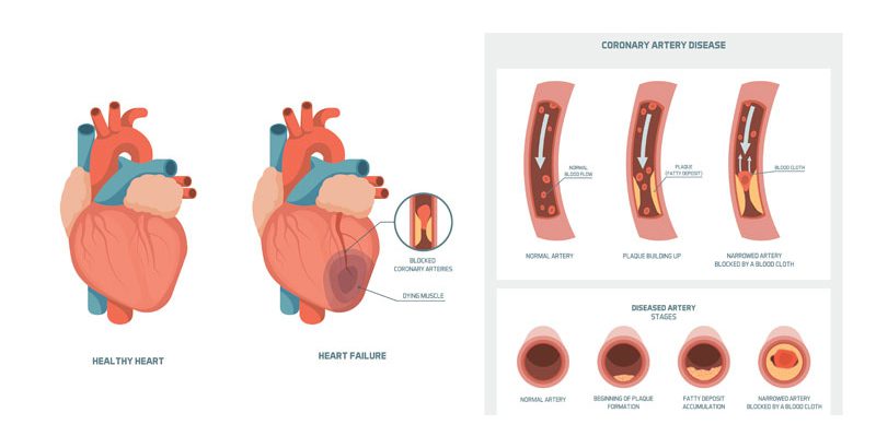 carolina-cardiology-associates-coronary-artery-disease-chart
