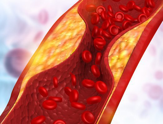 carolina-cardiology-associates-coronary-artery-disease