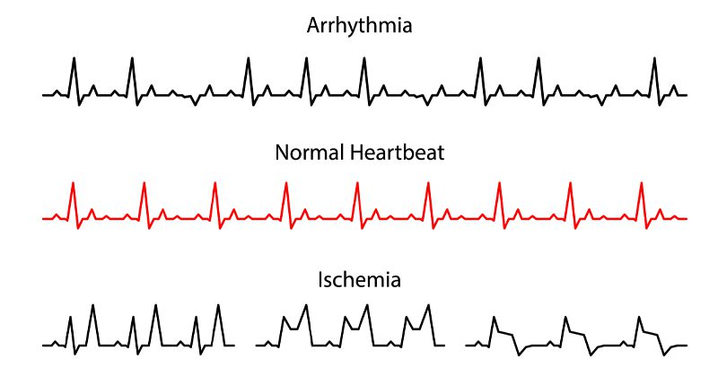 carolina-cardiology-associates-heart-beat-chart