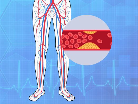 carolina-cardiology-associates-peripheral-artery-disease