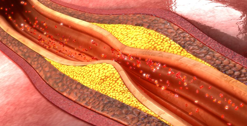 carolina-cardiology-associates-plaque-in-arteries